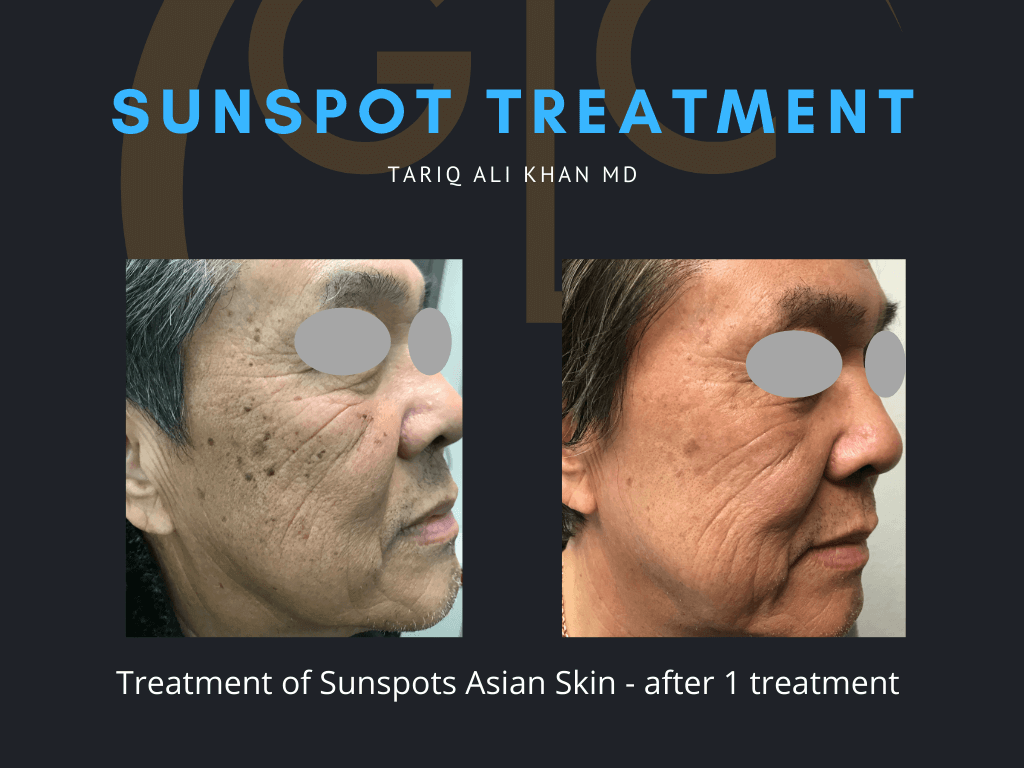 Gentle Care Laser Tustin & Long Beach Before and After picture - Sunspot treatment